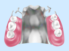 金属床義歯（チタン、コバルトクロム）