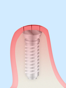 ステップ3：治癒期間