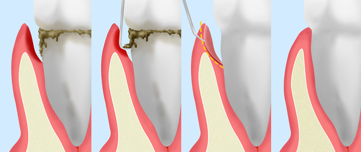 歯周ポケット掻把（そうは）術