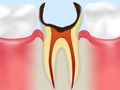 C4：歯根に達した虫歯